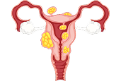 Cervical Cancer Treatment in Hyderabad