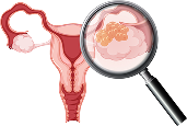 ovarian Cancer Treatment in Hyderabad