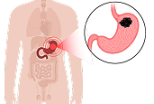 stomach Cancer Treatment in Hyderabad